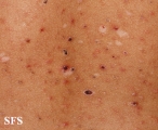 pityriasis lichenoides et varioliformis acuta