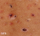 pityriasis lichenoides et varioliformis acuta