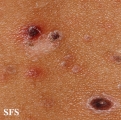 pityriasis lichenoides et varioliformis acuta