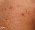 pityriasis lichenoides et varioliformis acuta