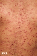 pityriasis lichenoides et varioliformis acuta
