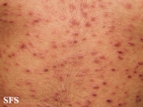 pityriasis lichenoides et varioliformis acuta