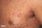 pityriasis lichenoides et varioliformis acuta