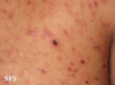 pityriasis lichenoides et varioliformis acuta