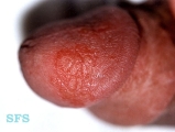 reiter's syndrome