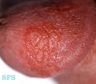 reiter's syndrome