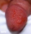 reiter's syndrome