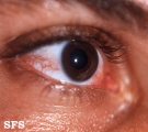reiter's syndrome