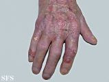 reiter's syndrome