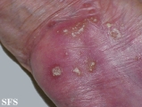 reiter's syndrome