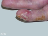 reiter's syndrome