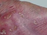 reiter's syndrome