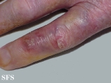 reiter's syndrome