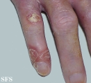 reiter's syndrome