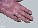 reiter's syndrome