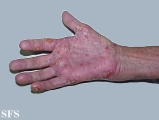 reiter's syndrome