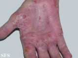 reiter's syndrome