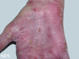 reiter's syndrome
