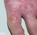 reiter's syndrome