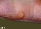 reiter's syndrome