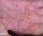 reiter's syndrome