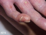 reiter's syndrome
