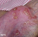 reiter's syndrome