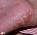 reiter's syndrome