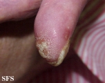 reiter's syndrome