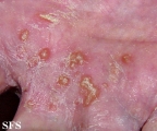 reiter's syndrome