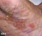 reiter's syndrome