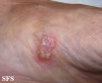 reiter's syndrome