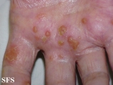 reiter's syndrome