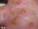 reiter's syndrome
