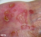 reiter's syndrome