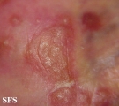 reiter's syndrome