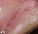 reiter's syndrome