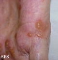 reiter's syndrome