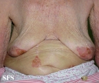 reiter's syndrome