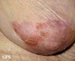 reiter's syndrome