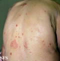 reiter's syndrome