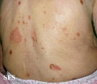 reiter's syndrome