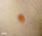 reiter's syndrome