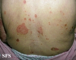 reiter's syndrome