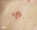 reiter's syndrome
