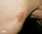 reiter's syndrome