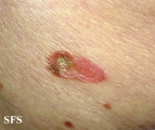 reiter's syndrome