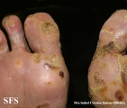 reiter's syndrome