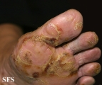 reiter's syndrome