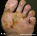 reiter's syndrome